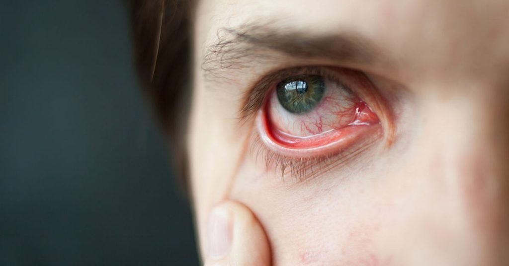 ader im auge geplatzt schlaganfall